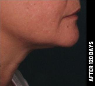 Ultherapy Before & After Patient #1558